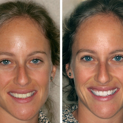 Teeth Whitening Powder